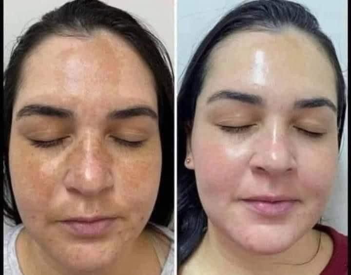 Chemical Peel